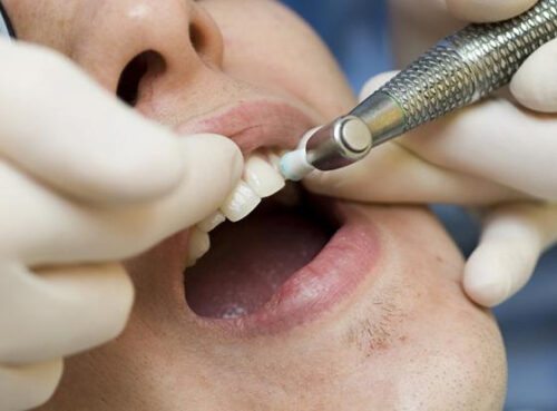 Врач рассказала, о чём может сигнализировать налёт на зубах Врач рассказала, о чём может сигнализировать налёт на зубах